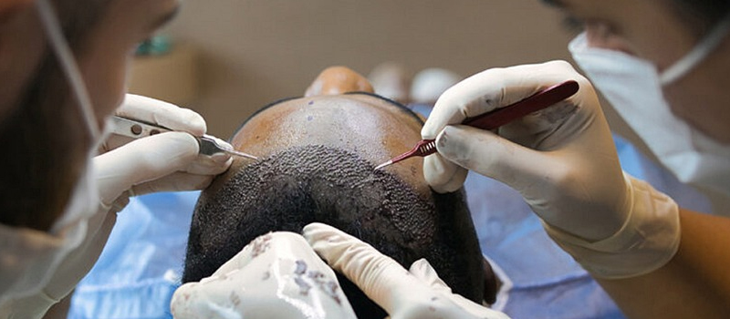 The Distinction Between Hair Transplant and Scalp Micropigmentation