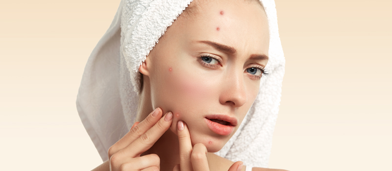 When to Contemplate Zits Scar Fillers